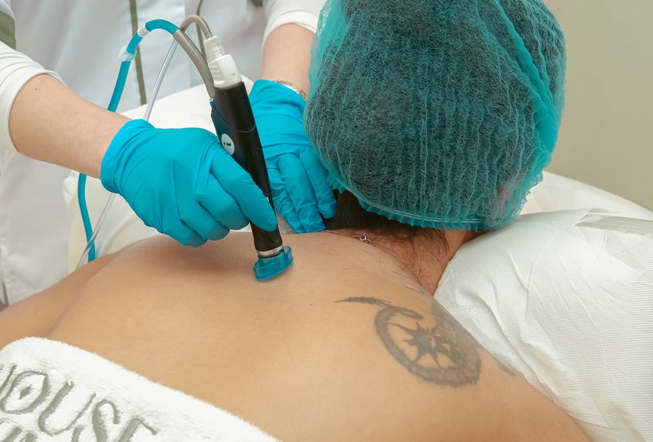 Indepartare tatuaj cu laser